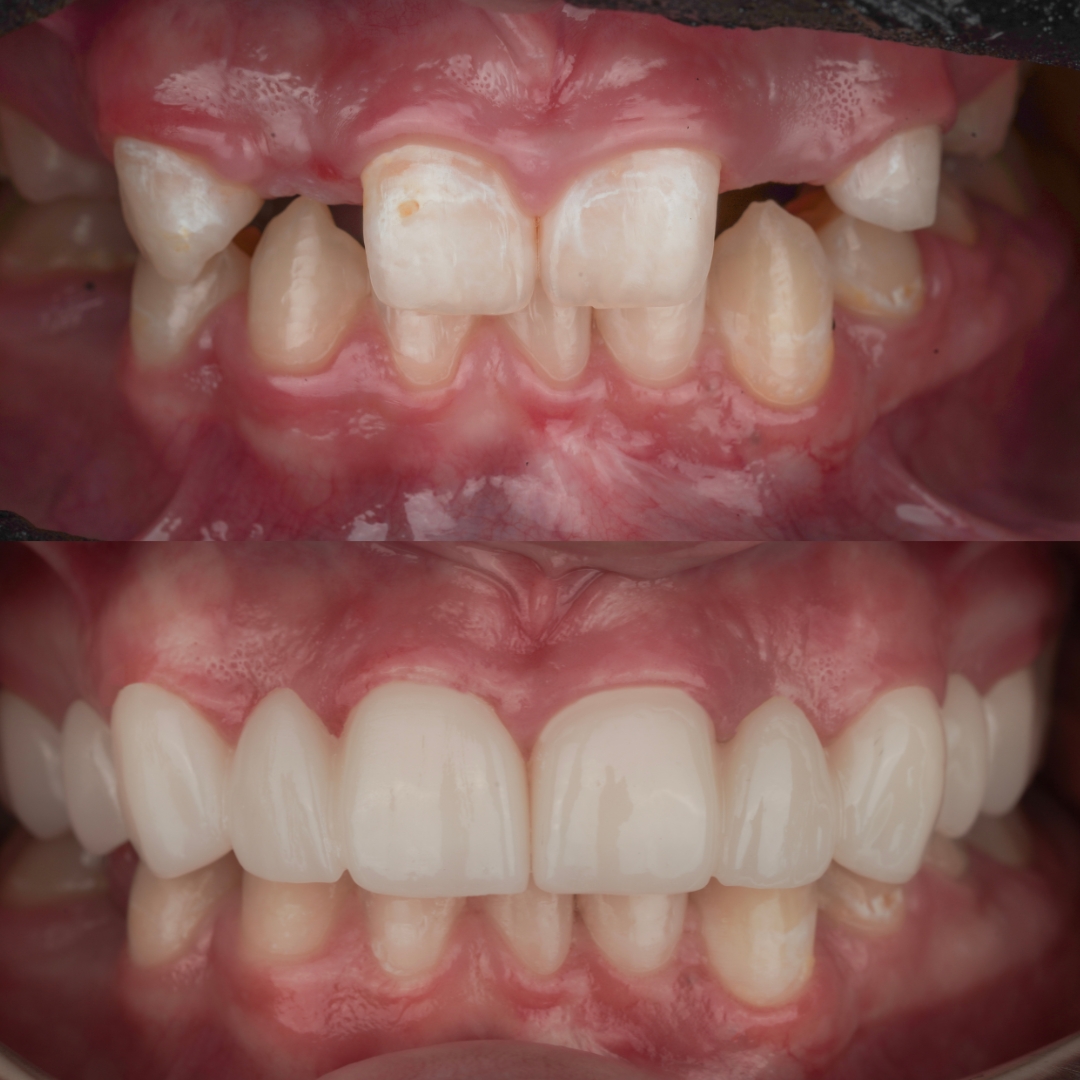 Before and after fixed dental bridge replacing missing teeth